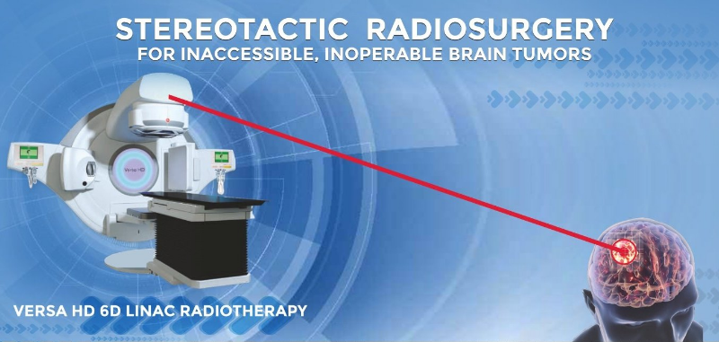 Stereotactic Radiosurgery (SRS) - Non-Surgical Treatment For Brain Tumors