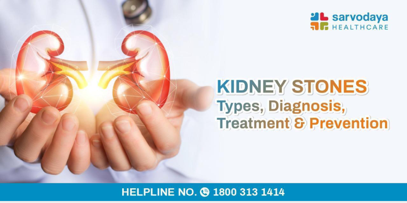 Kidney Stones - Types, Diagnosis, Treatment & Prevention