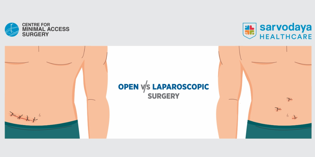 Open Surgery v/s Laparoscopic Surgery: Which is better?
