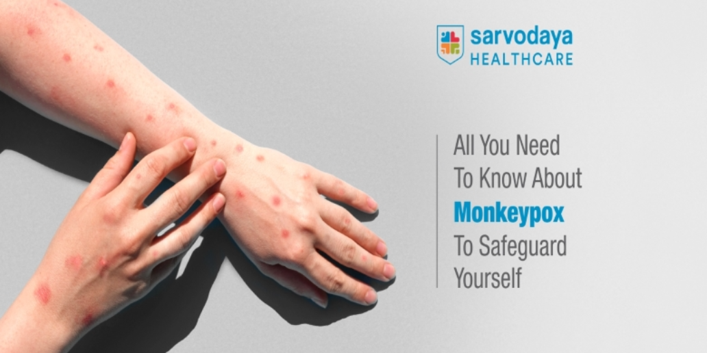 All you need to know about Monkeypox to Safeguard Yourself